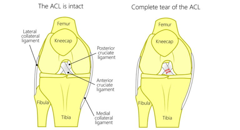 ACL Reconstruction: What You Need to Know ACL Reconstruction: What You Need to Know