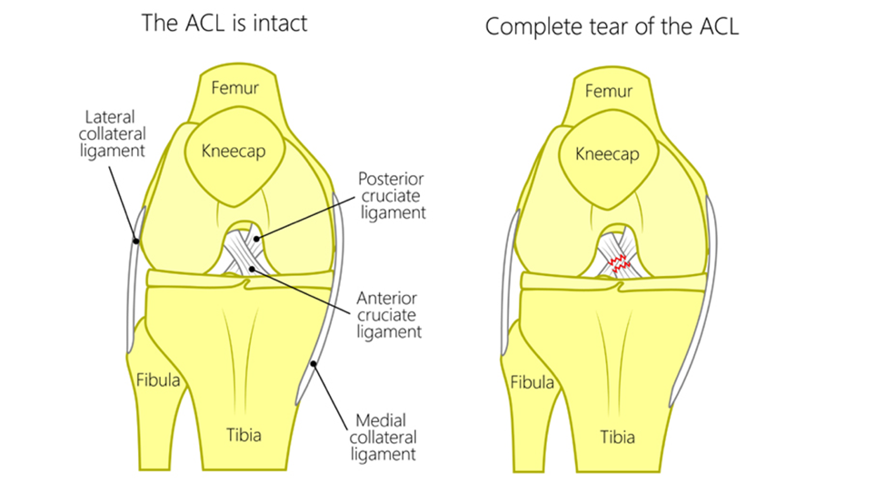 acl reconstruction