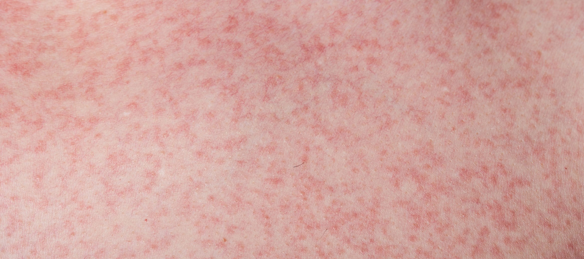 Dengue Rash