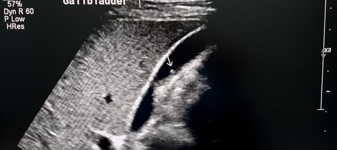 What You Need to Know about Gallbladder Polyps