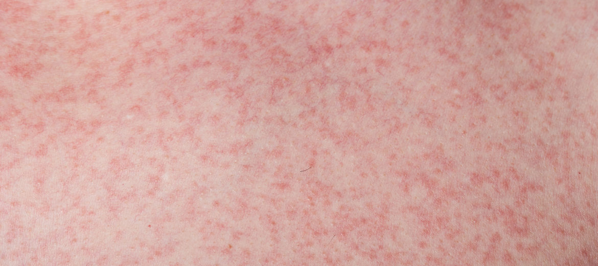 Dengue rashes: Appearance, Symptoms and Meaning