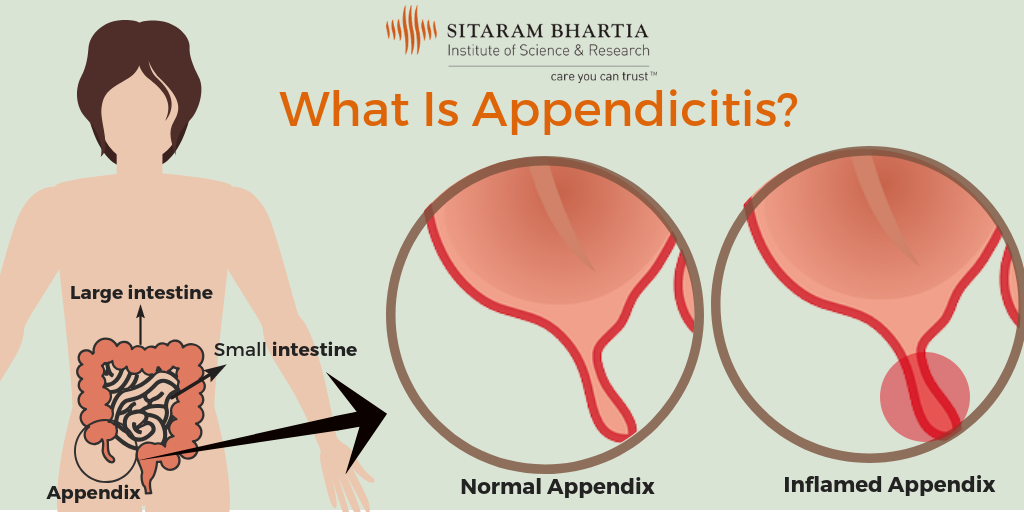 Laparoscopic appendectomy