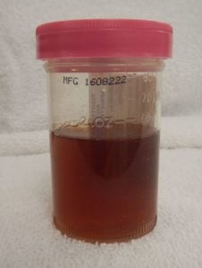 Blood in urine