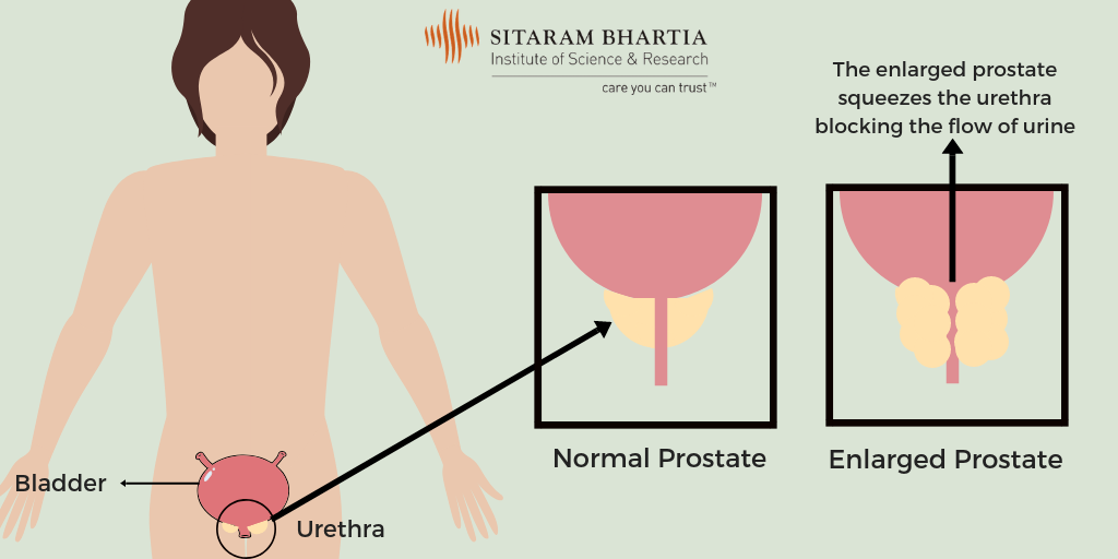 Prostate enlargement