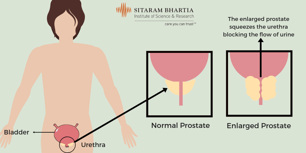 how to control prostate enlargement in hindi