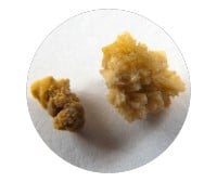 kidney stone