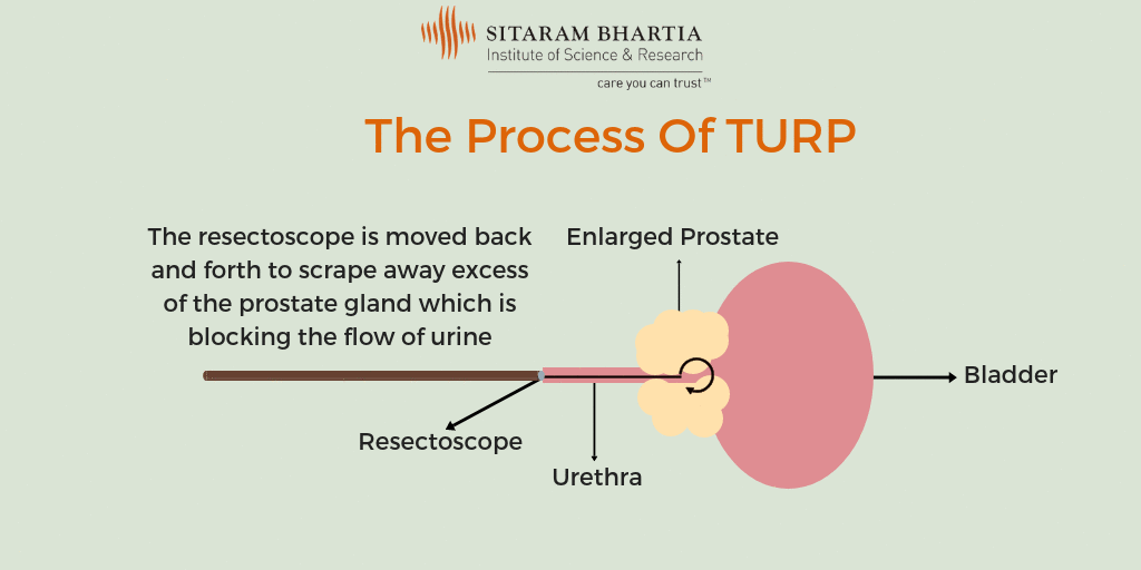 turp Sitaram Bhartia Institute of Science and Research