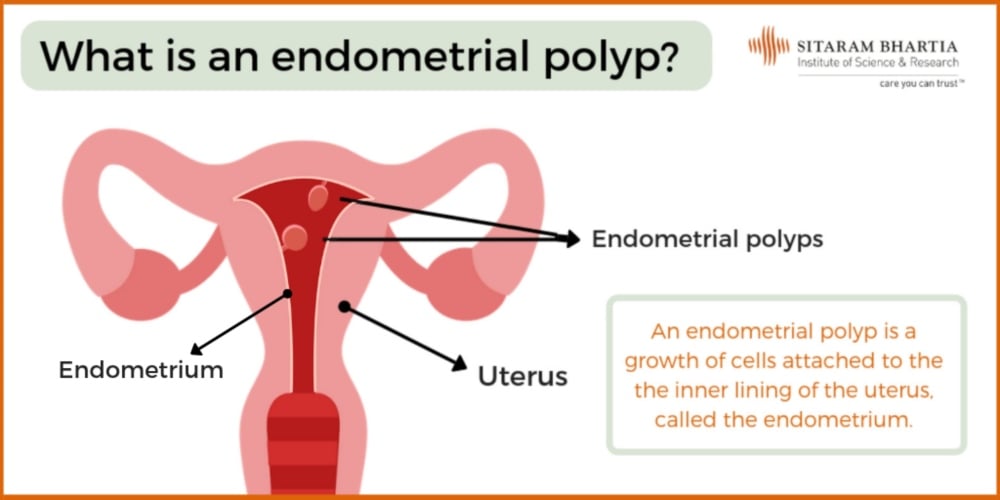 endometrial-polyp