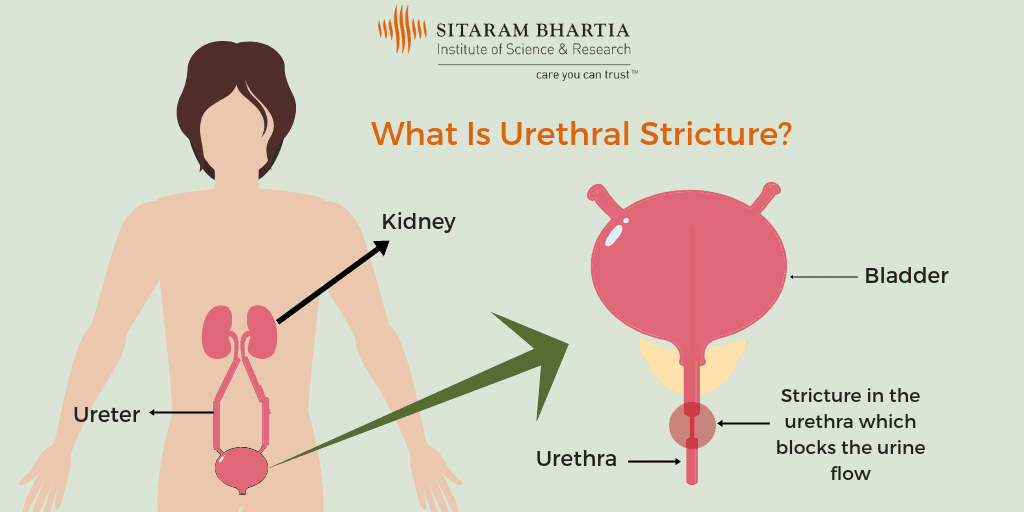 Urethral stricture