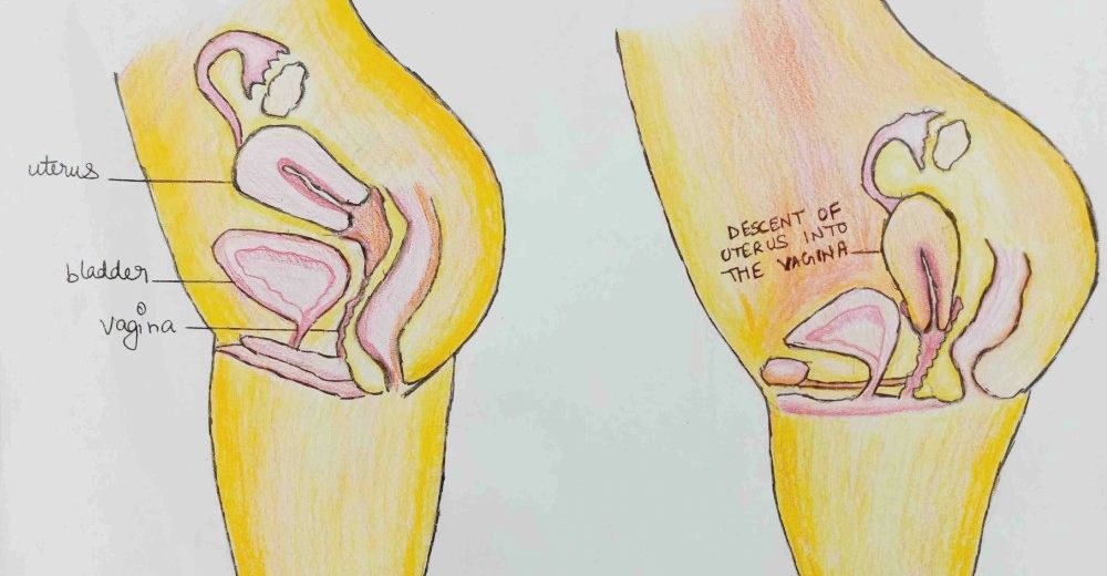 Prolapse in women – The Pelvic Floor Disorder You May Not Know You Have