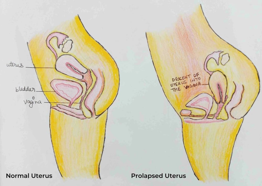 Prolapse