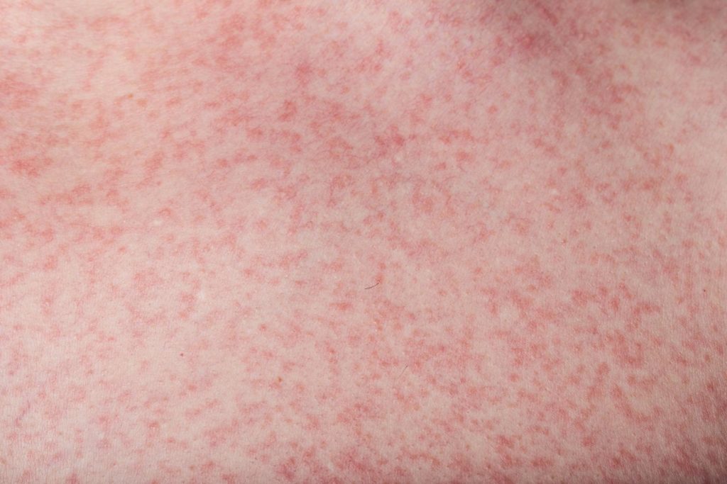 Dengue Rashes 1 Sitaram Bhartia Institute Of Science And Research