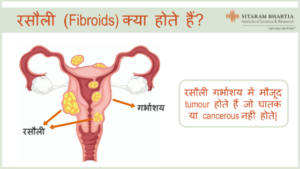 Fibroid in Hindi - रसौली का Meaning, इलाज और अन्य टिप्स!
