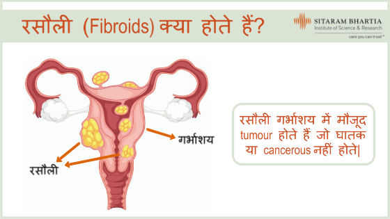 Fibroid In Hindi रस ल क Meaning इल ज और अन य ट प स