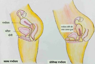prolapse meaning in hindi