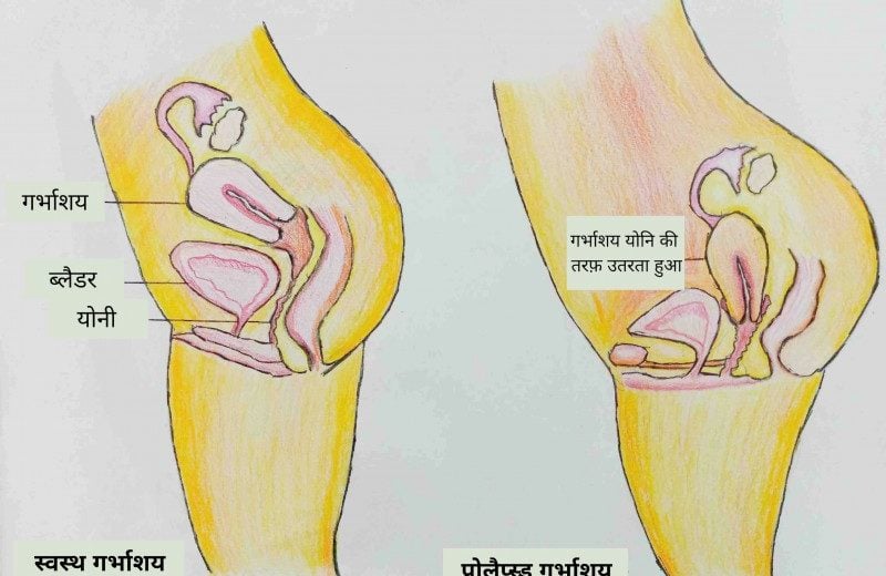 prolapse meaning in hindi