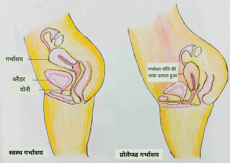 prolapse meaning in hindi