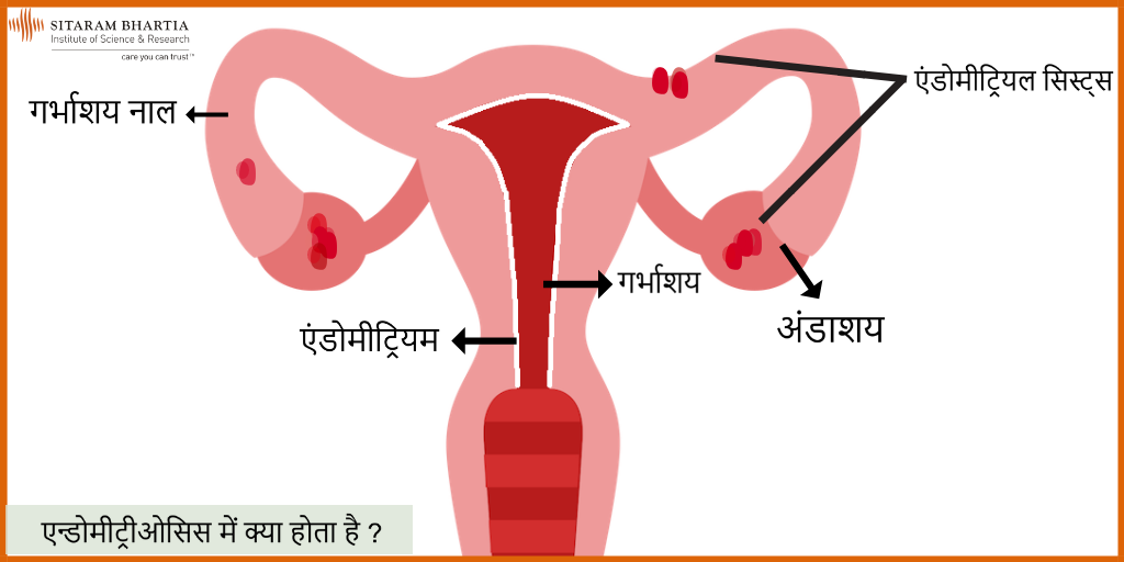 Endometriosis Meaning In Hindi म ड कल सह यत स प ए दर द स र हत Sitaram Bhartia Blog