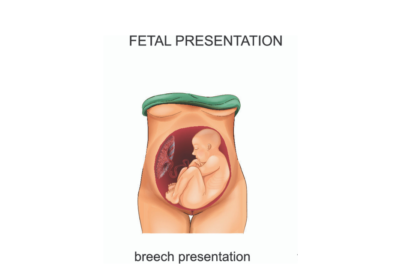 BREECH-BABY-MEANS