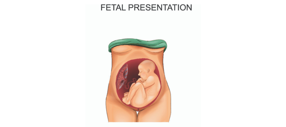 Breech Baby: Meaning, Reasons and Ways to Turn