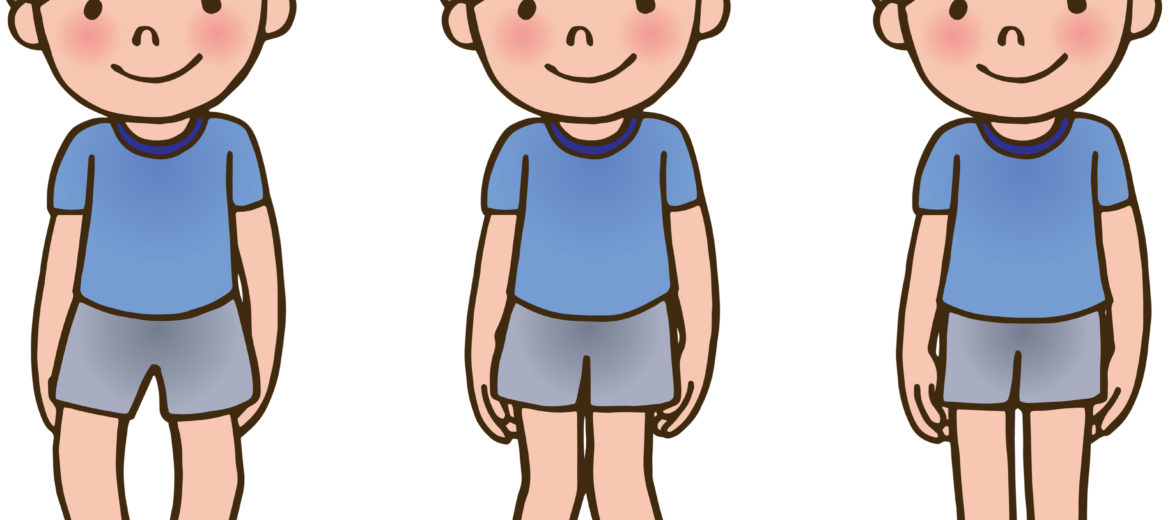 Bow Legs in Children: Causes, Correction and Tips