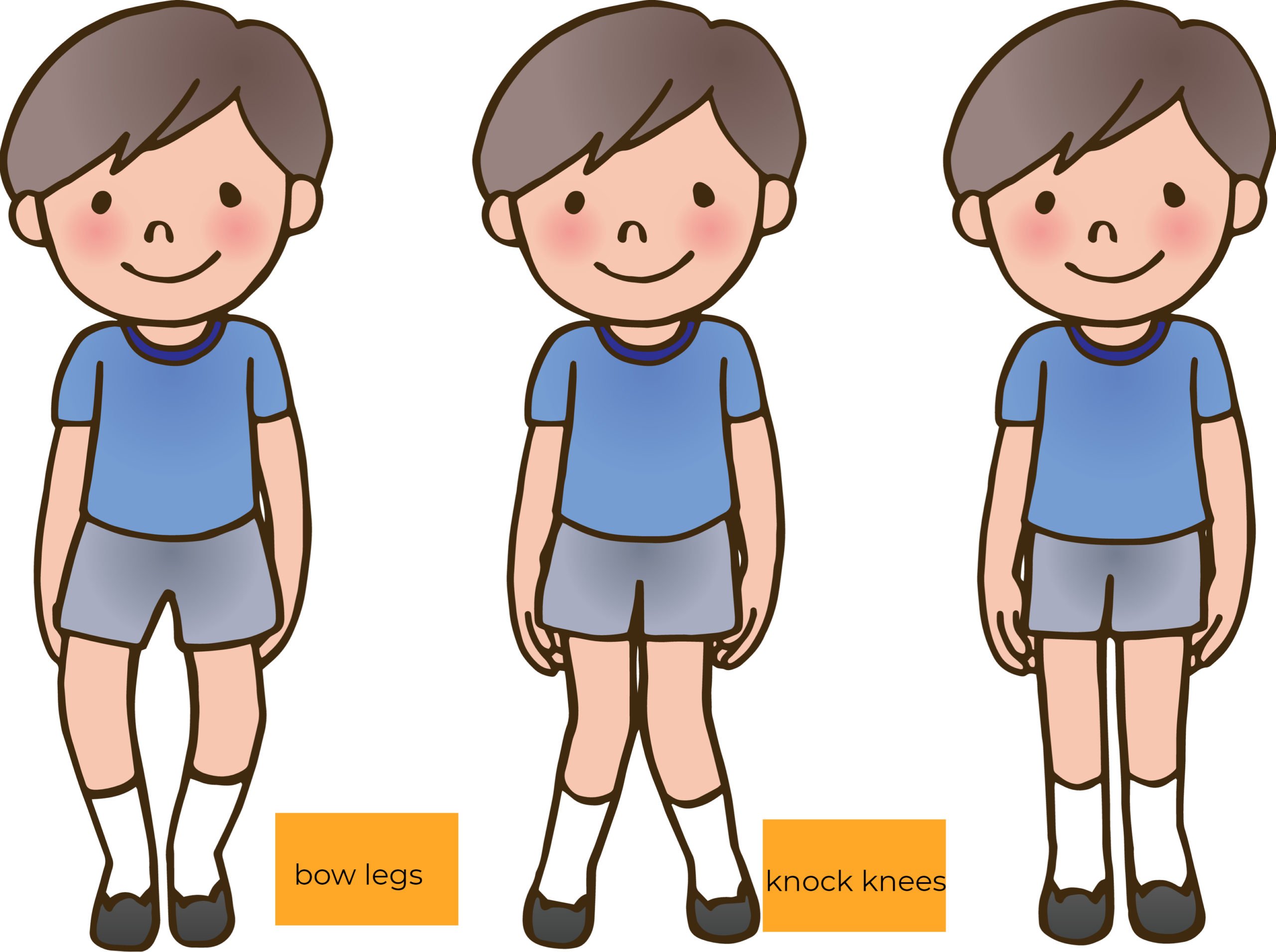 Natte sneeuw Geroosterd Crack pot Bow Legs in Children: Causes, Correction and Tips - Sitaram Bhartia Blog