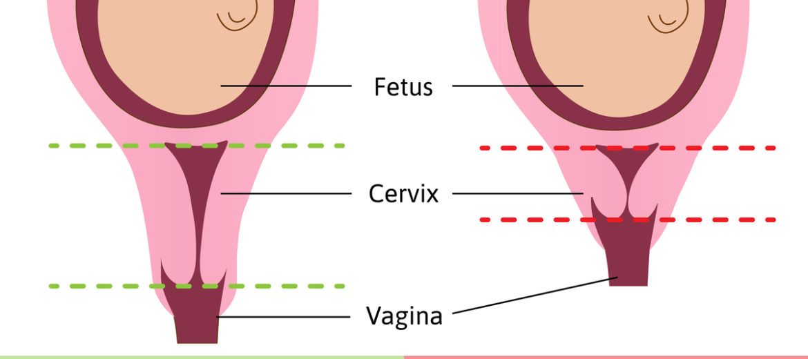 Short Cervical Length: Is a Normal Delivery Possible?
