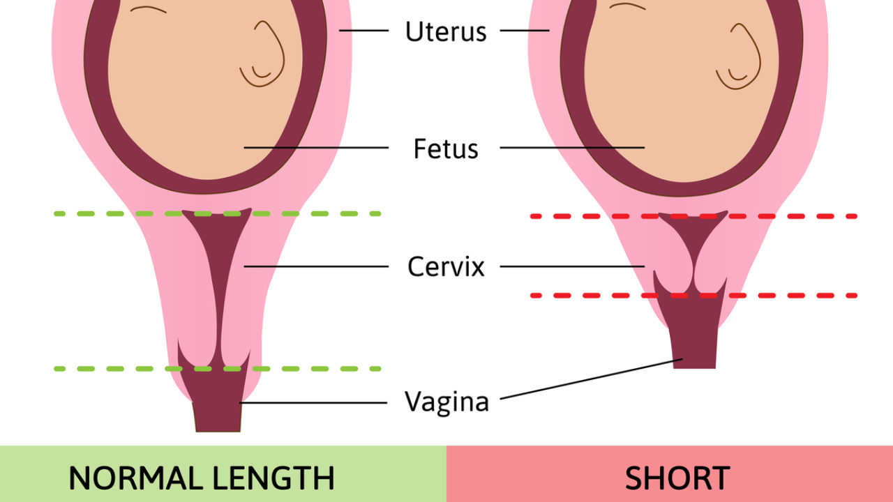 Short Cervical Length: Is a Normal Delivery Possible? | Sitaram Bhartia Blog Short Cervical Length: Is a Normal Delivery Possible? | Sitaram Bhartia Blog