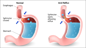 hiatal hernia - acidity