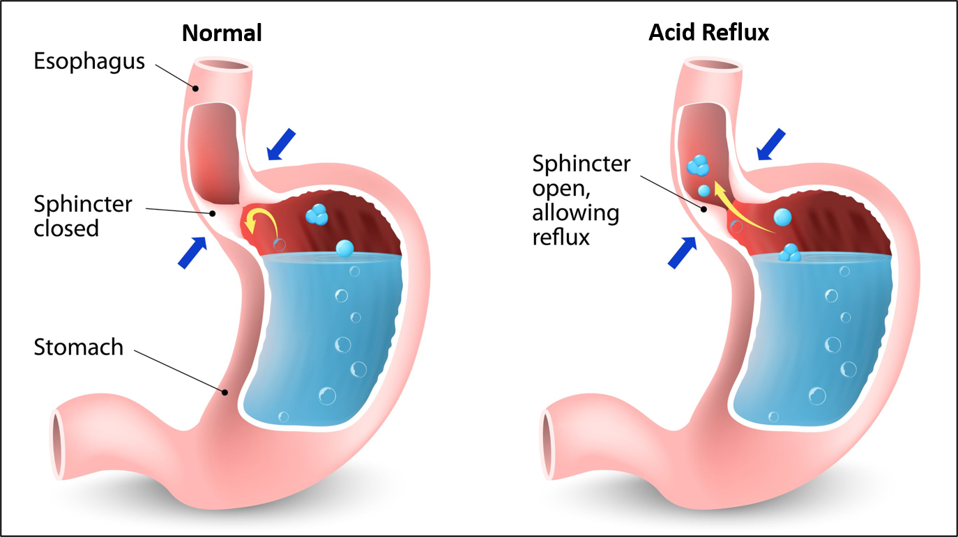 Acid Reflux With Hiatal Hernia illustration Sitaram Bhartia Institute 