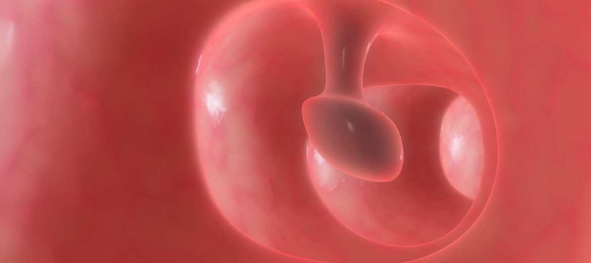 Don’t Be Afraid of a  Polypectomy! Here’s What to Know