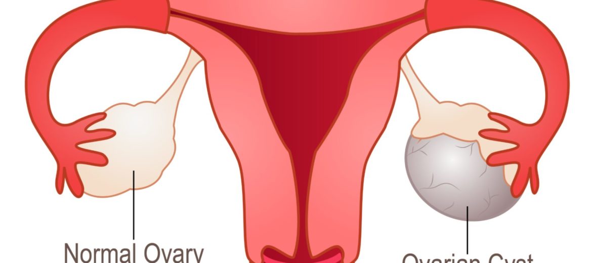 Ovarian Cystectomy: Remove That Troublesome Cyst!