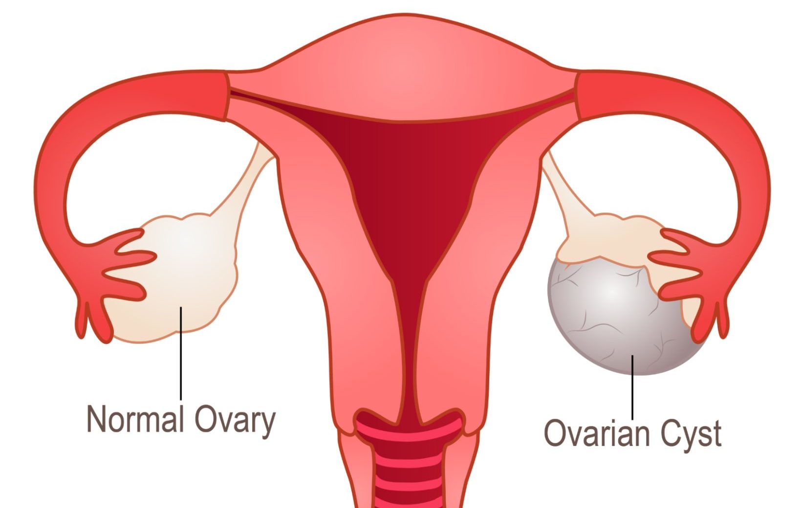 Ovarian cyst symptoms