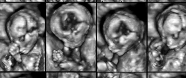anomaly scan ultrasound image